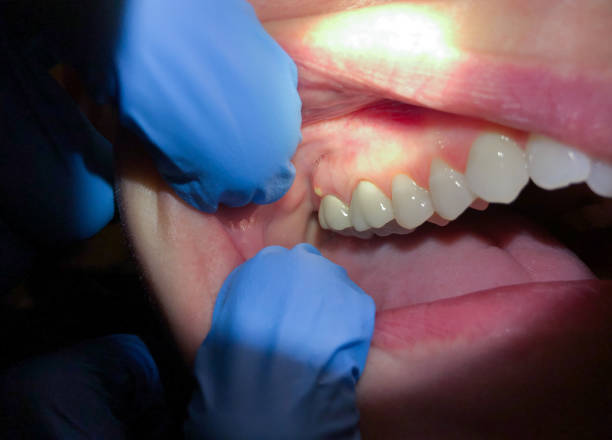 Best Emergency Dental Care for Broken or Chipped Teeth in Westhampton Beach, NY